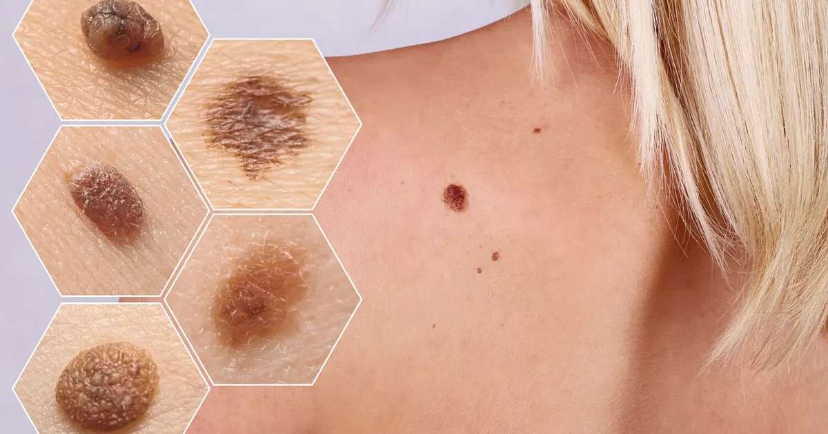 Skin Cancer : Types, Stages, Symptoms, Causes and Tests